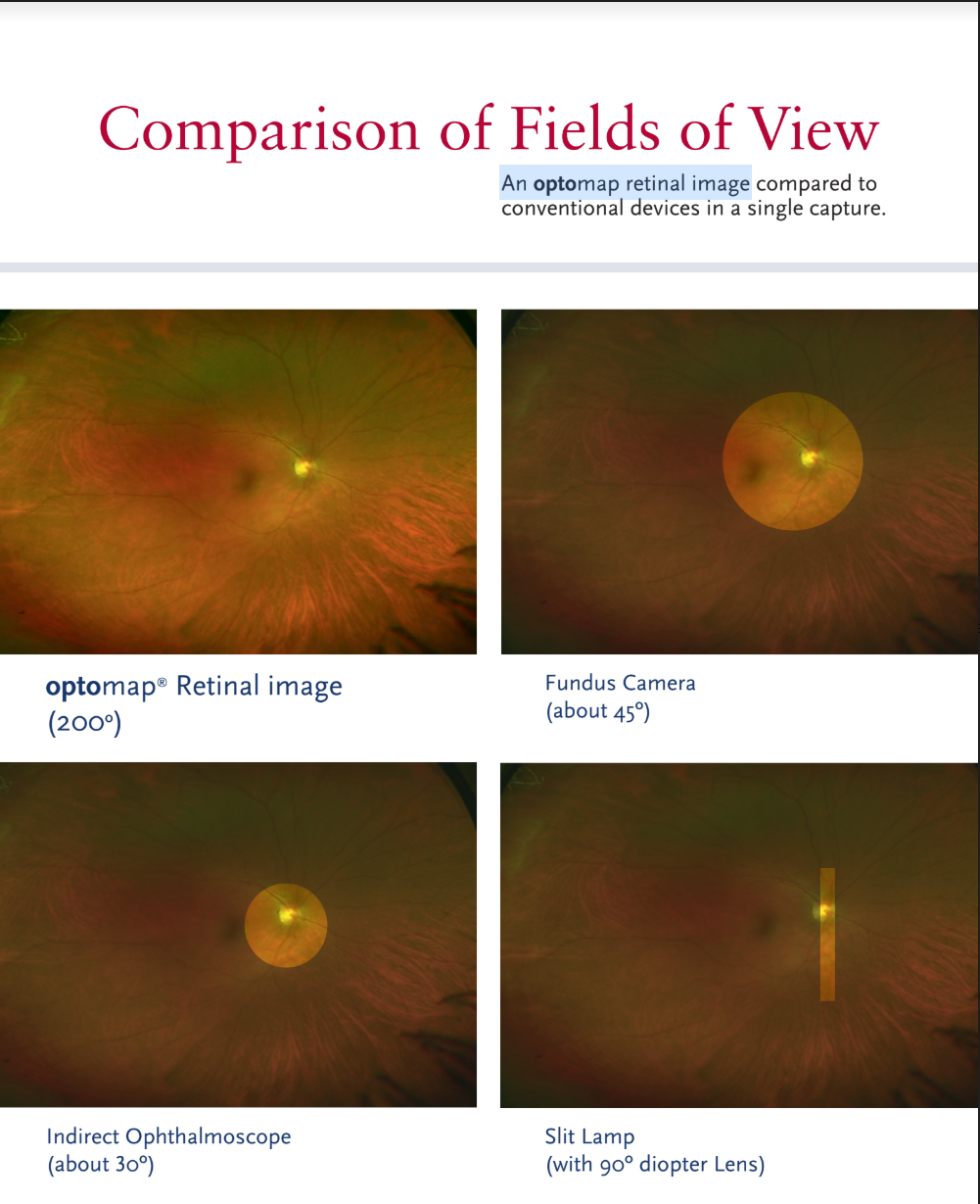 Optomap retinal imaging